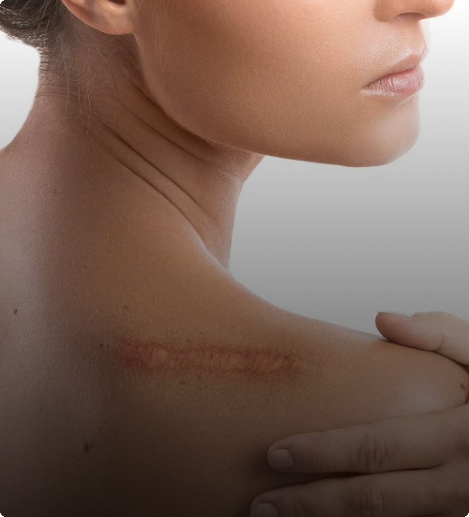 Keloid Treatment
